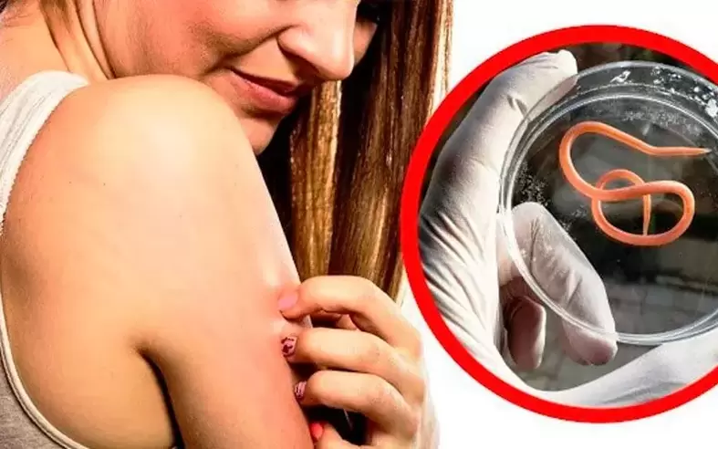 κνησμός και ερεθισμός λόγω παρασίτων στο σώμα